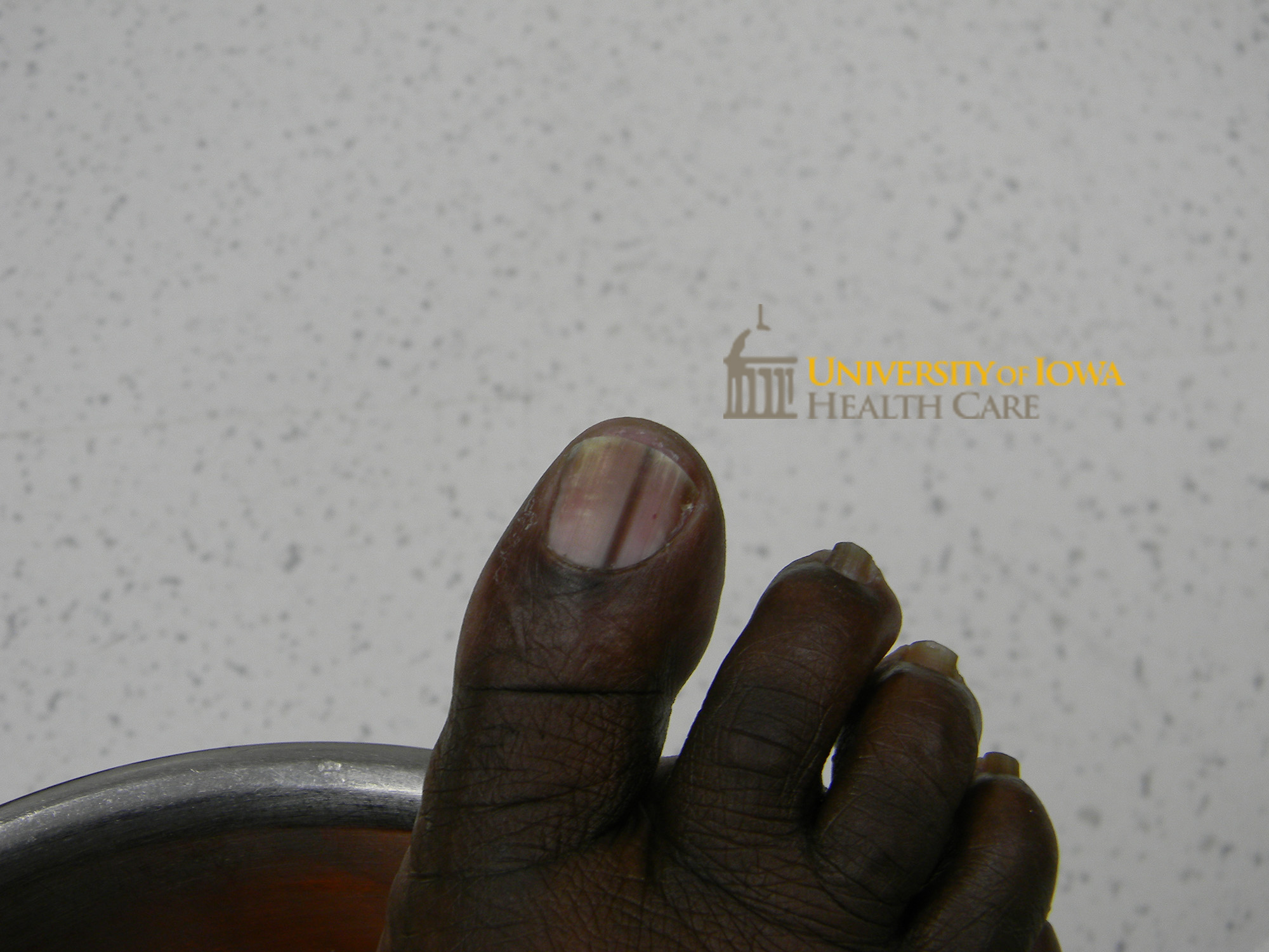 Longitudinal brown band on the toenail. (click images for higher resolution).